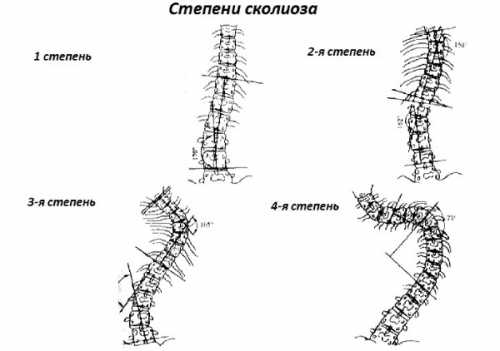 Степени сколиоза